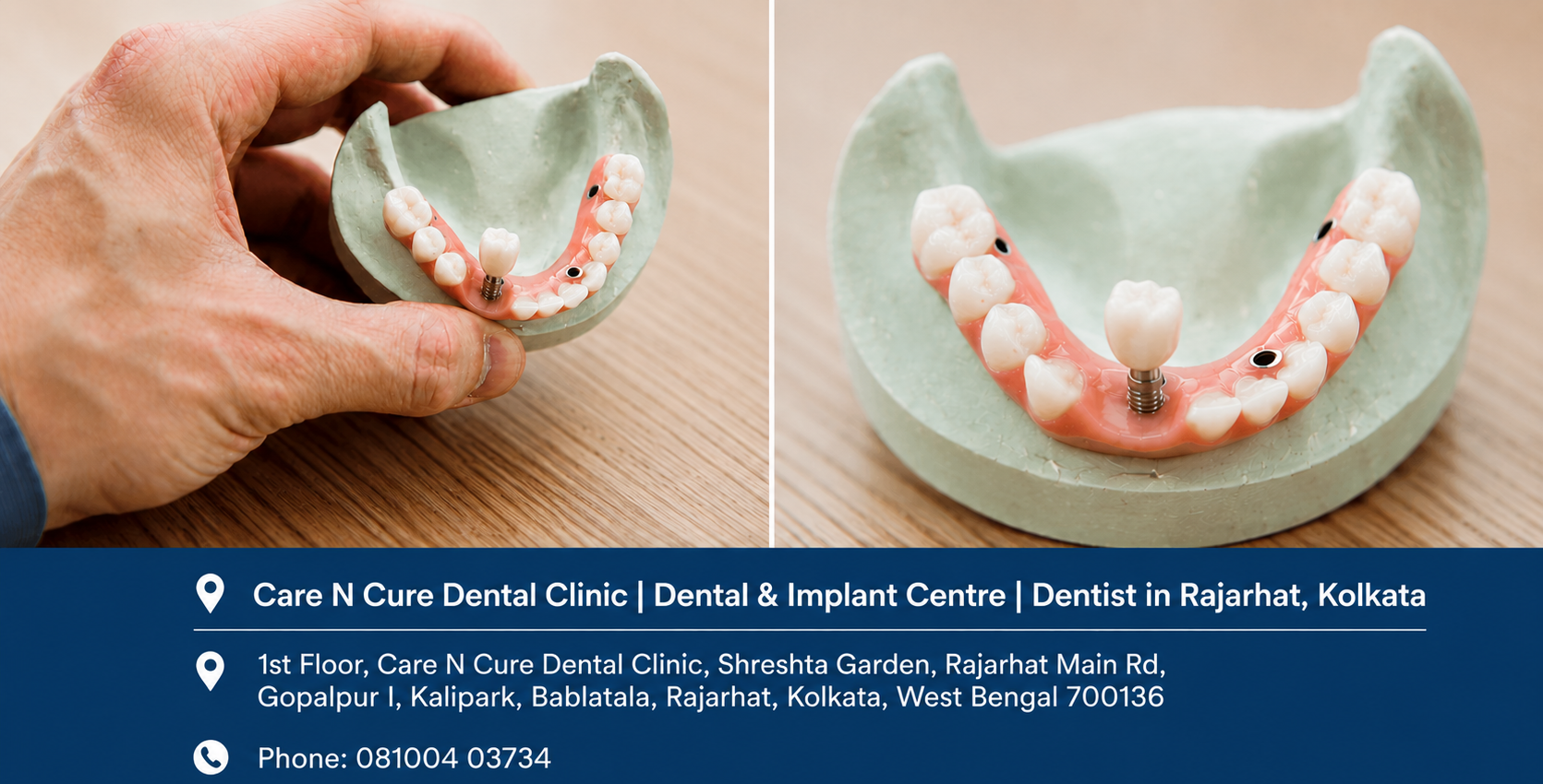Implant dentist demonstrating dental implants and top brands in India at Care N Cure Dental Clinic in Rajarhat Kolkata.