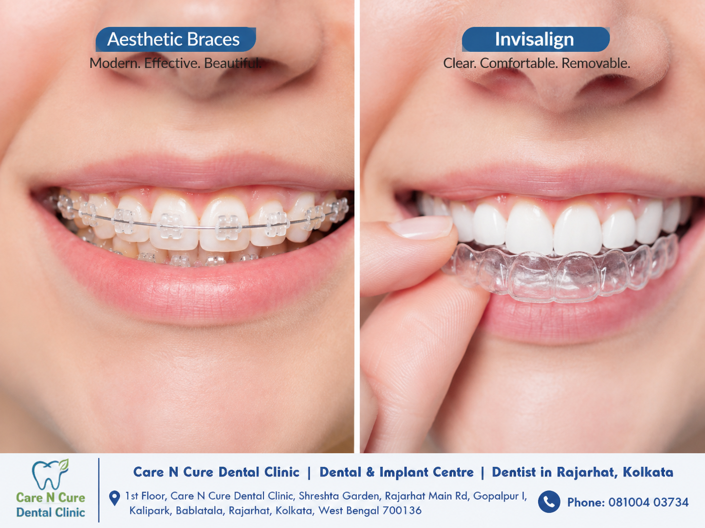 aesthetic braces vs invisalign clear aligners comparison at care n cure dental clinic in rajarhat kolkata